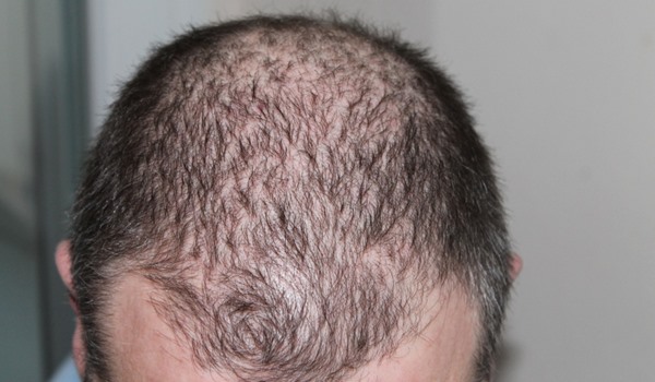 Hair Transplants Explained